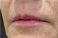 Dermal Fillers Before Photo by Michael Law, MD; Raleigh, NC - Case 35757