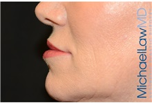 Dermal Fillers After Photo by Michael Law, MD; Raleigh, NC - Case 35758