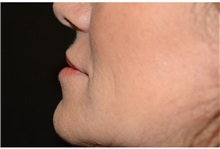 Dermal Fillers Before Photo by Michael Law, MD; Raleigh, NC - Case 35758