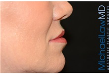 Dermal Fillers After Photo by Michael Law, MD; Raleigh, NC - Case 35758