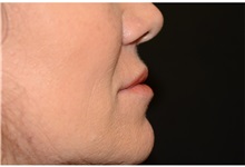 Dermal Fillers Before Photo by Michael Law, MD; Raleigh, NC - Case 35758