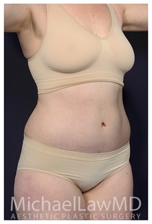 Tummy Tuck After Photo by Michael Law, MD; Raleigh, NC - Case 35795