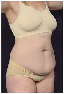 Tummy Tuck Before Photo by Michael Law, MD; Raleigh, NC - Case 35795