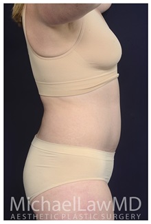 Tummy Tuck After Photo by Michael Law, MD; Raleigh, NC - Case 35795