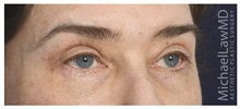 Eyelid Surgery After Photo by Michael Law, MD; Raleigh, NC - Case 35806