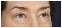 Eyelid Surgery Before Photo by Michael Law, MD; Raleigh, NC - Case 35806