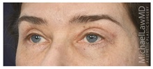 Eyelid Surgery After Photo by Michael Law, MD; Raleigh, NC - Case 35806