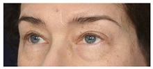 Eyelid Surgery Before Photo by Michael Law, MD; Raleigh, NC - Case 35806