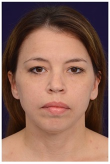 Chin Augmentation Before Photo by Michael Law, MD; Raleigh, NC - Case 35807