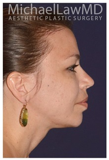 Chin Augmentation After Photo by Michael Law, MD; Raleigh, NC - Case 35807