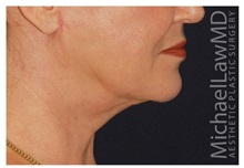 Chin Augmentation After Photo by Michael Law, MD; Raleigh, NC - Case 35813