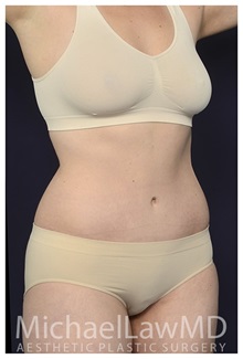 Tummy Tuck After Photo by Michael Law, MD; Raleigh, NC - Case 35816