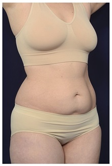 Tummy Tuck Before Photo by Michael Law, MD; Raleigh, NC - Case 35816