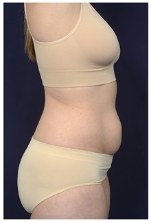 Tummy Tuck Before Photo by Michael Law, MD; Raleigh, NC - Case 35816