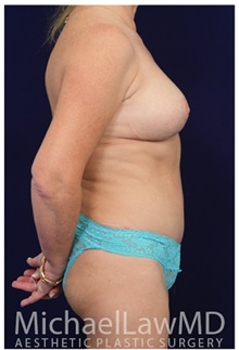 Body Contouring After Photo by Michael Law, MD; Raleigh, NC - Case 35821