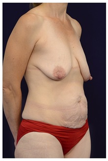 Body Contouring Before Photo by Michael Law, MD; Raleigh, NC - Case 35822