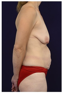 Body Contouring Before Photo by Michael Law, MD; Raleigh, NC - Case 35822