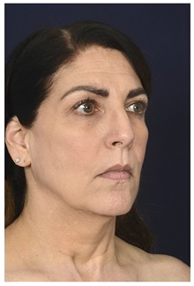 Facelift Before Photo by Michael Law, MD; Raleigh, NC - Case 35855