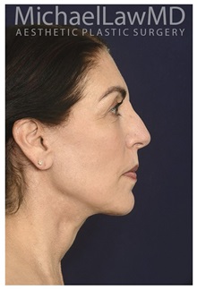 Facelift After Photo by Michael Law, MD; Raleigh, NC - Case 35855
