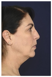Facelift Before Photo by Michael Law, MD; Raleigh, NC - Case 35855