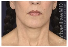 Facelift After Photo by Michael Law, MD; Raleigh, NC - Case 35856