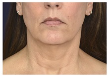 Facelift Before Photo by Michael Law, MD; Raleigh, NC - Case 35856
