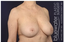 Breast Implant Revision After Photo by Michael Law, MD; Raleigh, NC - Case 41288