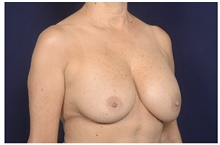 Breast Implant Revision Before Photo by Michael Law, MD; Raleigh, NC - Case 41288