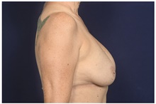 Breast Implant Revision Before Photo by Michael Law, MD; Raleigh, NC - Case 41288