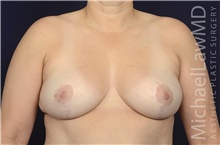 Breast Reduction After Photo by Michael Law, MD; Raleigh, NC - Case 41289
