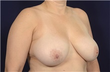 Breast Reduction Before Photo by Michael Law, MD; Raleigh, NC - Case 41289