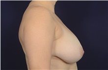 Breast Reduction Before Photo by Michael Law, MD; Raleigh, NC - Case 41289