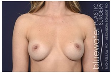 Breast Augmentation After Photo by Michael Law, MD; Raleigh, NC - Case 41292
