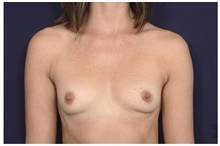 Breast Augmentation Before Photo by Michael Law, MD; Raleigh, NC - Case 41292