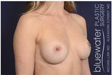 Breast Augmentation After Photo by Michael Law, MD; Raleigh, NC - Case 41292