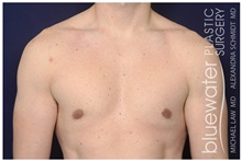 Male Breast Reduction After Photo by Michael Law, MD; Raleigh, NC - Case 41299