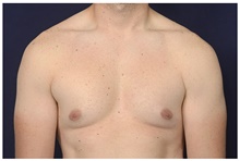 Male Breast Reduction Before Photo by Michael Law, MD; Raleigh, NC - Case 41299