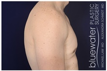Male Breast Reduction After Photo by Michael Law, MD; Raleigh, NC - Case 41299