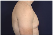 Male Breast Reduction Before Photo by Michael Law, MD; Raleigh, NC - Case 41299
