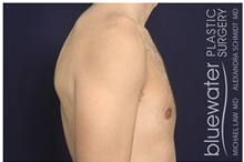Male Breast Reduction After Photo by Michael Law, MD; Raleigh, NC - Case 41302