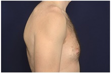 Male Breast Reduction Before Photo by Michael Law, MD; Raleigh, NC - Case 41302
