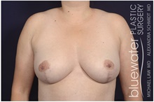 Breast Reduction After Photo by Michael Law, MD; Raleigh, NC - Case 42124