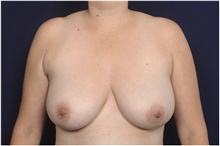 Breast Reduction Before Photo by Michael Law, MD; Raleigh, NC - Case 42124