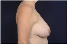 Breast Reduction Before Photo by Michael Law, MD; Raleigh, NC - Case 42124