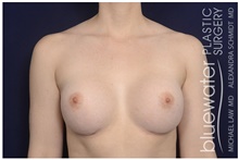Breast Augmentation After Photo by Michael Law, MD; Raleigh, NC - Case 42125