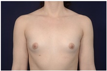 Breast Augmentation Before Photo by Michael Law, MD; Raleigh, NC - Case 42125