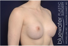 Breast Augmentation After Photo by Michael Law, MD; Raleigh, NC - Case 42125
