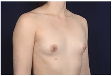 Breast Augmentation Before Photo by Michael Law, MD; Raleigh, NC - Case 42125