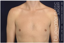 Male Breast Reduction After Photo by Michael Law, MD; Raleigh, NC - Case 42126