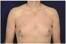 Male Breast Reduction Before Photo by Michael Law, MD; Raleigh, NC - Case 42126
